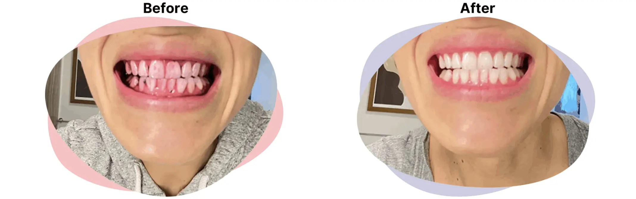 features of Autobrush electric toothbrush